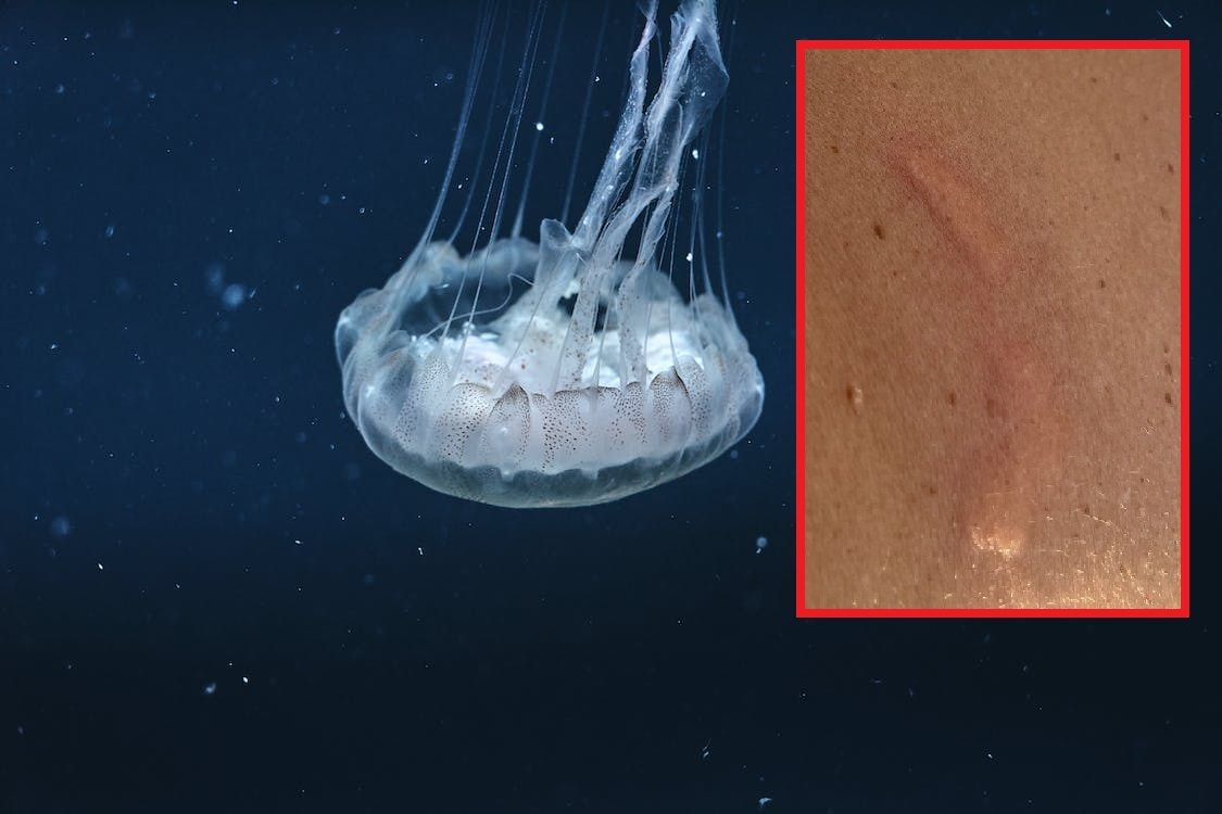 Kupače u Zadru opekle meduze - Plaža ubrzo ispražnjena