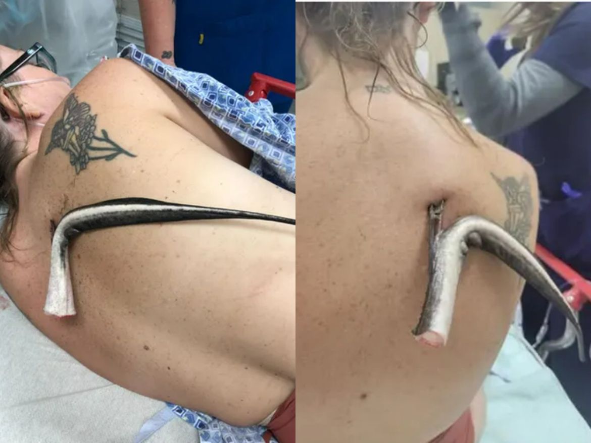 Plivala u moru pa osjetila peckanje po leđima - Uslijedio je šok: "Mislila sam da ću umrijeti"