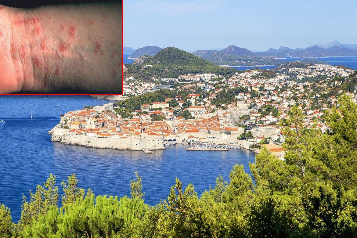 U Dubrovniku se pojavio svrab, ovo je potrebno znati!