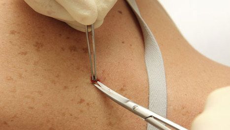 Geslo kampanje Euromelanoma 2022: “Nije važno koliko godina imaš, nego koliko si se godina sunčao”