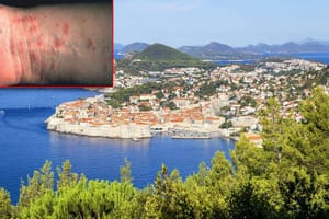 U Dubrovniku se pojavio svrab, ovo je potrebno znati!